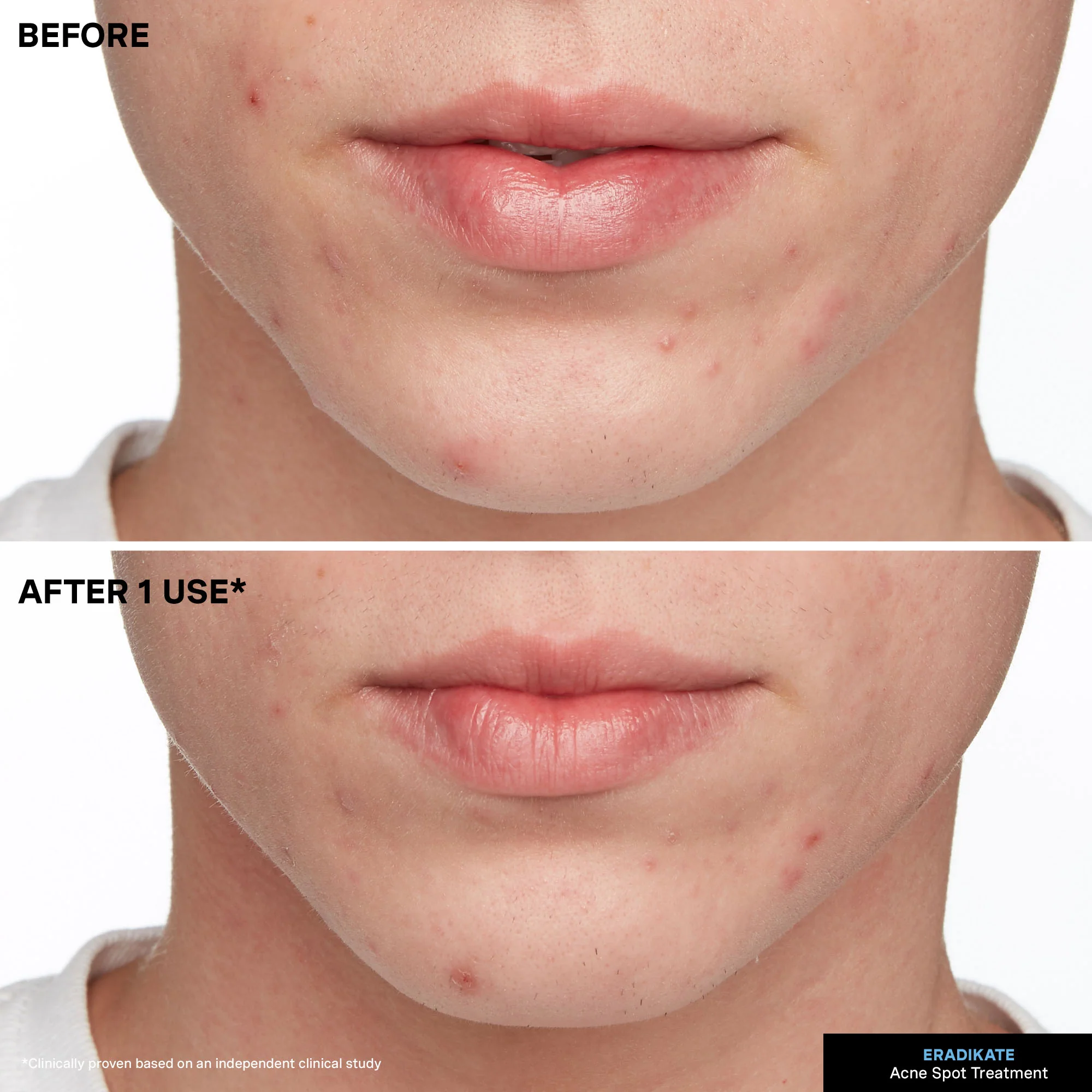 EradiKate® 10% Sulfur Blemish Treatment - Image 4