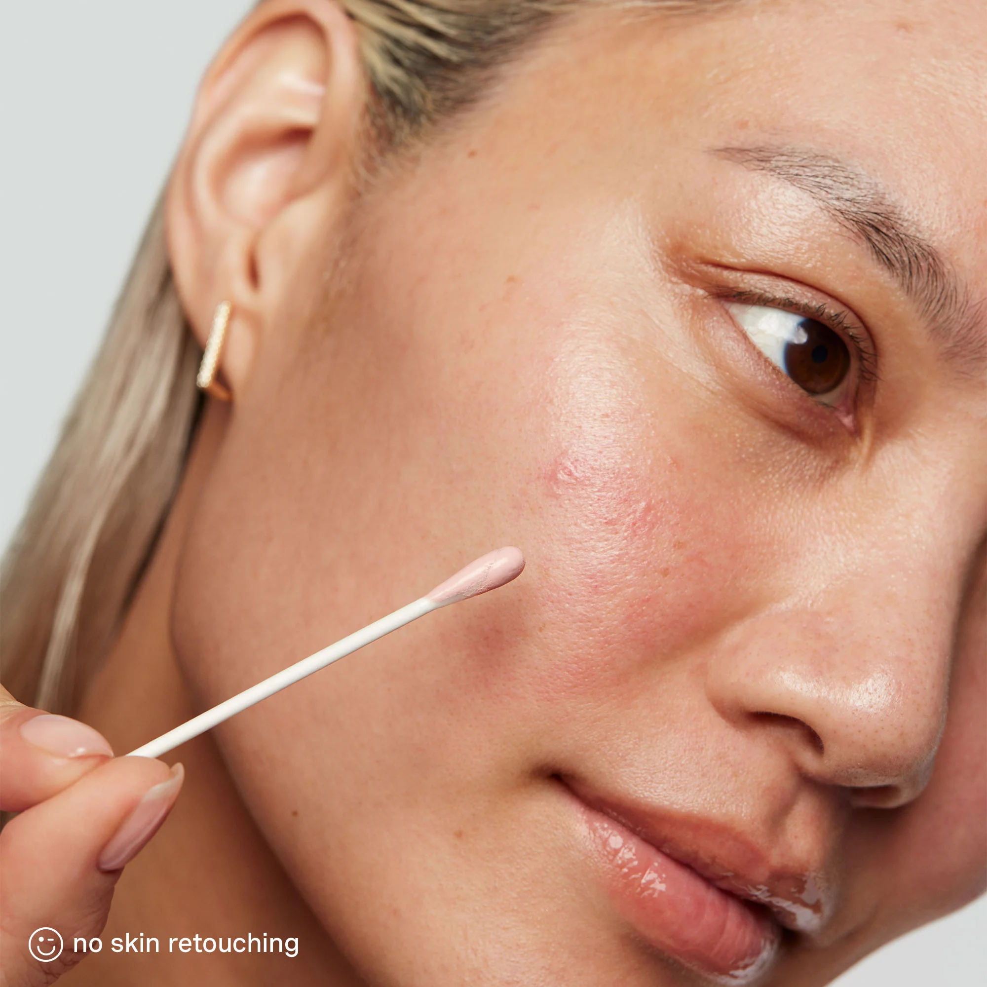 EradiKate® 10% Sulfur Blemish Treatment - Image 5