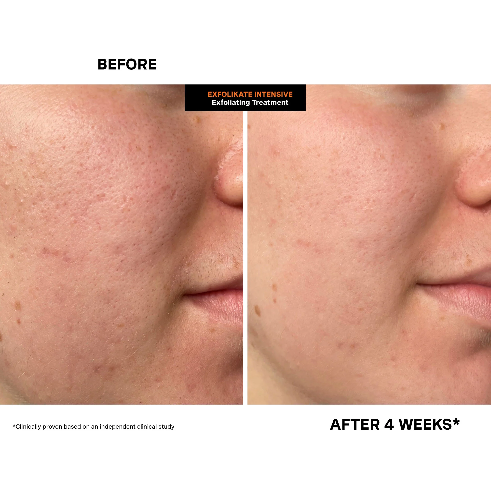 ExfoliKate® Intensive Exfoliating Treatment - Image 5